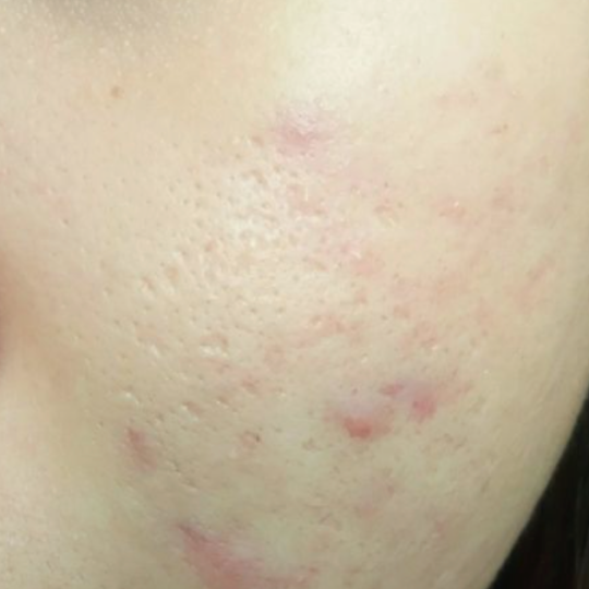 Điều trị mụn