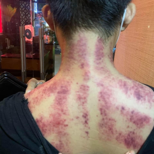 Bấm huyệt trị liệu Cổ Vai Gáy